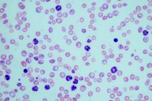 Una nueva técnica con células CAR-T logra la remisión de un tipo de leucemia fatal en dos adolescentes