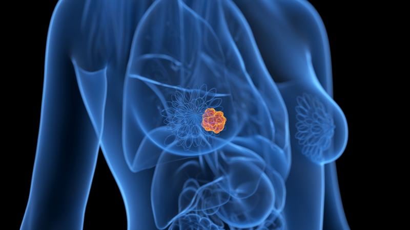 Día Mundial contra el Cáncer de Mama: tres claves que redefinen el abordaje médico y replantean los tratamientos