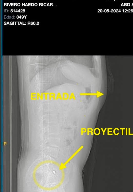 Radiografía de la herida recibida por Ricardo Rivero Haedo en el asalto