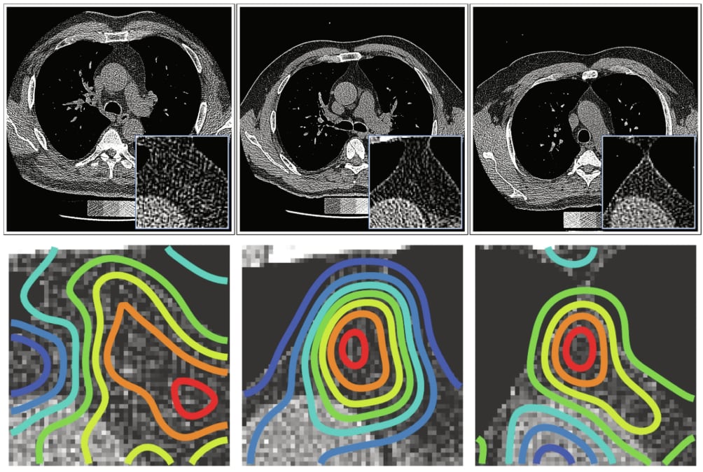 El pequeño órgano que se daba por terminado y que ahora aparece ligado al riesgo de muerte y enfermedad 6 Explicabilidad: Mapas de prominencia. Imágenes representativas de tomografía computarizada de la cohorte FHS superpuestas con los mapas de prominencia generados mediante oclusión, utilizando la característica más importante, que resalta las regiones del timo en las que se centra el modelo al realizar sus predicciones. Los mapas de prominencia se muestran en el corte central del timo, y la escala de color del chorro se utiliza para indicar la intensidad de la contribución