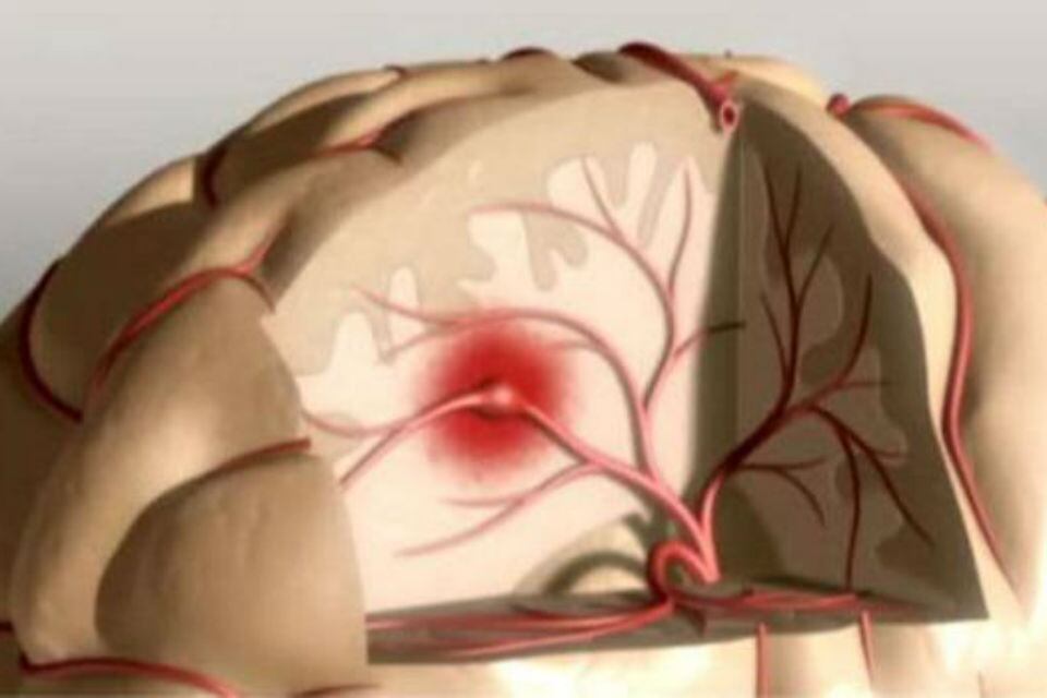 Los estudios determinarían que Oliveras sufrió un accidente cerebrovascular isquémico (ACV) provocado por una obstrucción en una de las arterias. Moroni indicó al respecto que se está haciendo un tratamiento médico para liberara esa obturación.