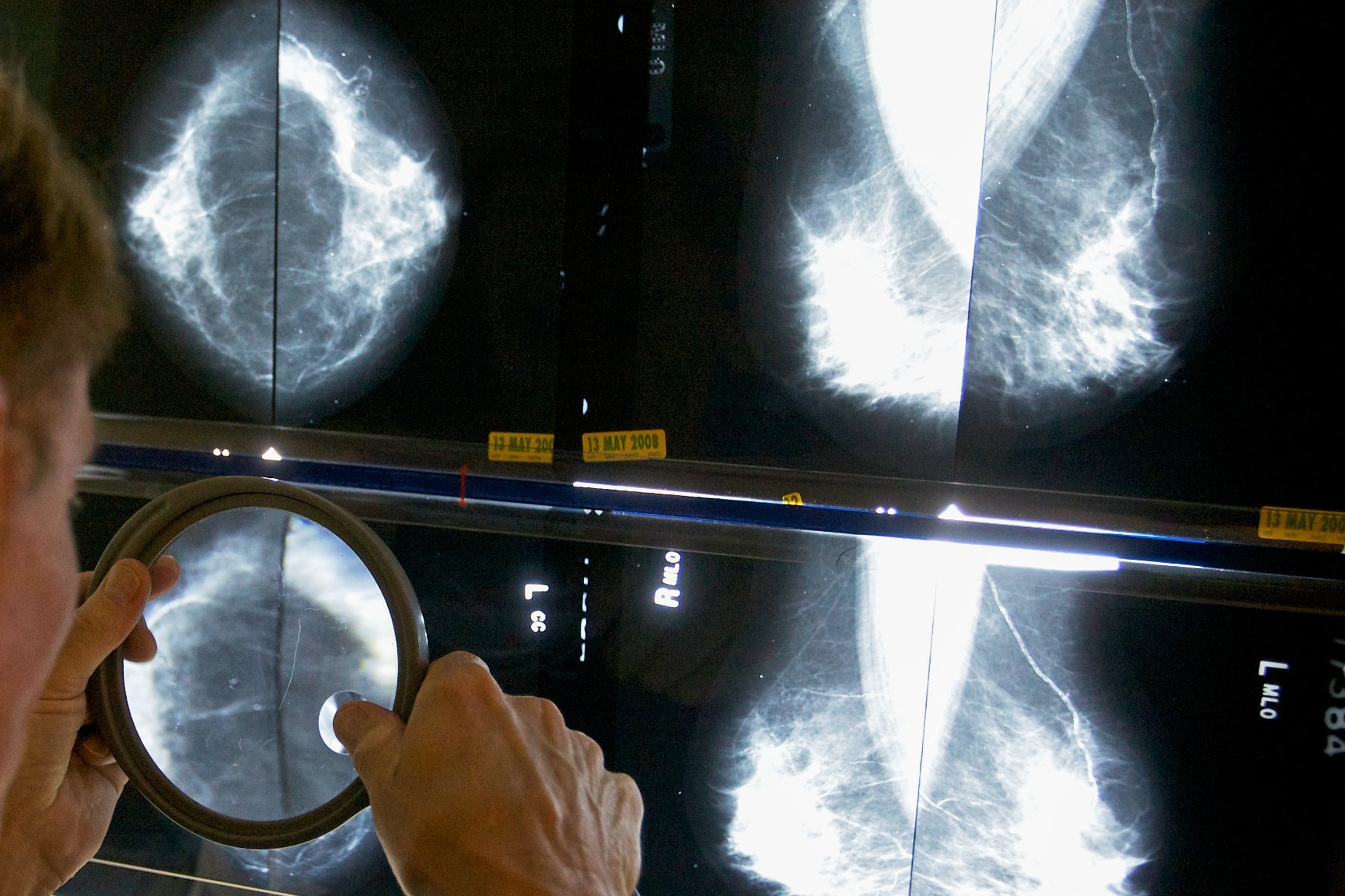 Los especialistas plantean reforzar la prevención cardiovascular en quienes atravesaron un cáncer de mama