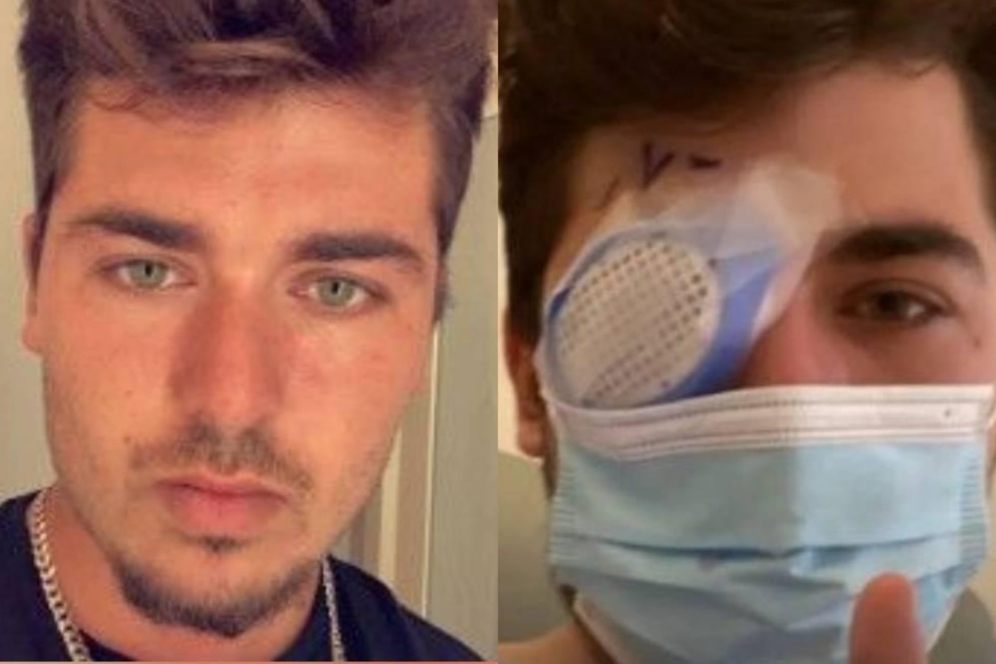 Fue a dormir una siesta con los lentes de contacto puestos y cuando despertó estaba ciego: “Los parásitos se comieron mi ojo”