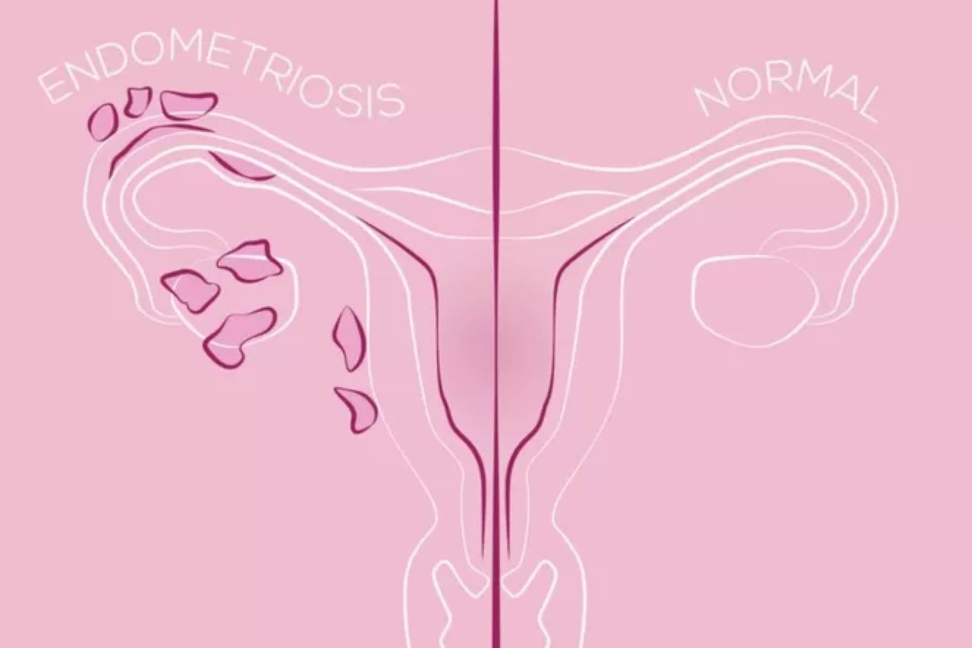 Así se ve un útero con endometriosis, en comparación con uno que no padece esta enfermedad