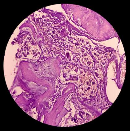 50 de cada 100 tumores de cordoma crecen en el hueso sacro.