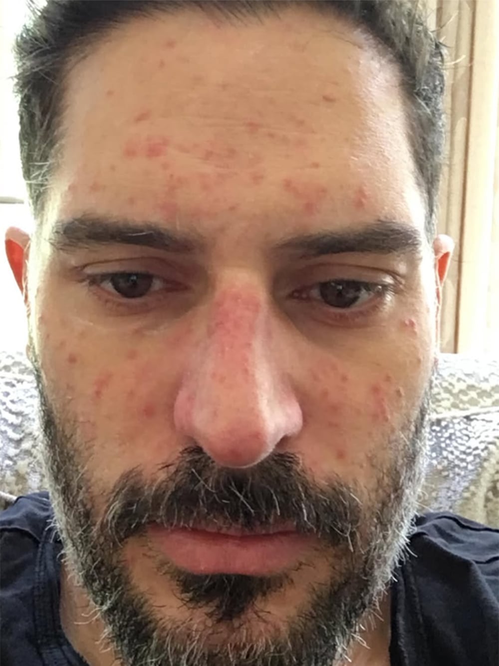 Joe Manganiello mostró las impactantes secuelas de la extraña enfermedad que padece: “No puedo creer que esté vivo” 8 Otra de las imágenes que el actor compartió en sus redes, en este caso, para mostrar las lesiones cutáneas que le provocó su extraña enfermedad