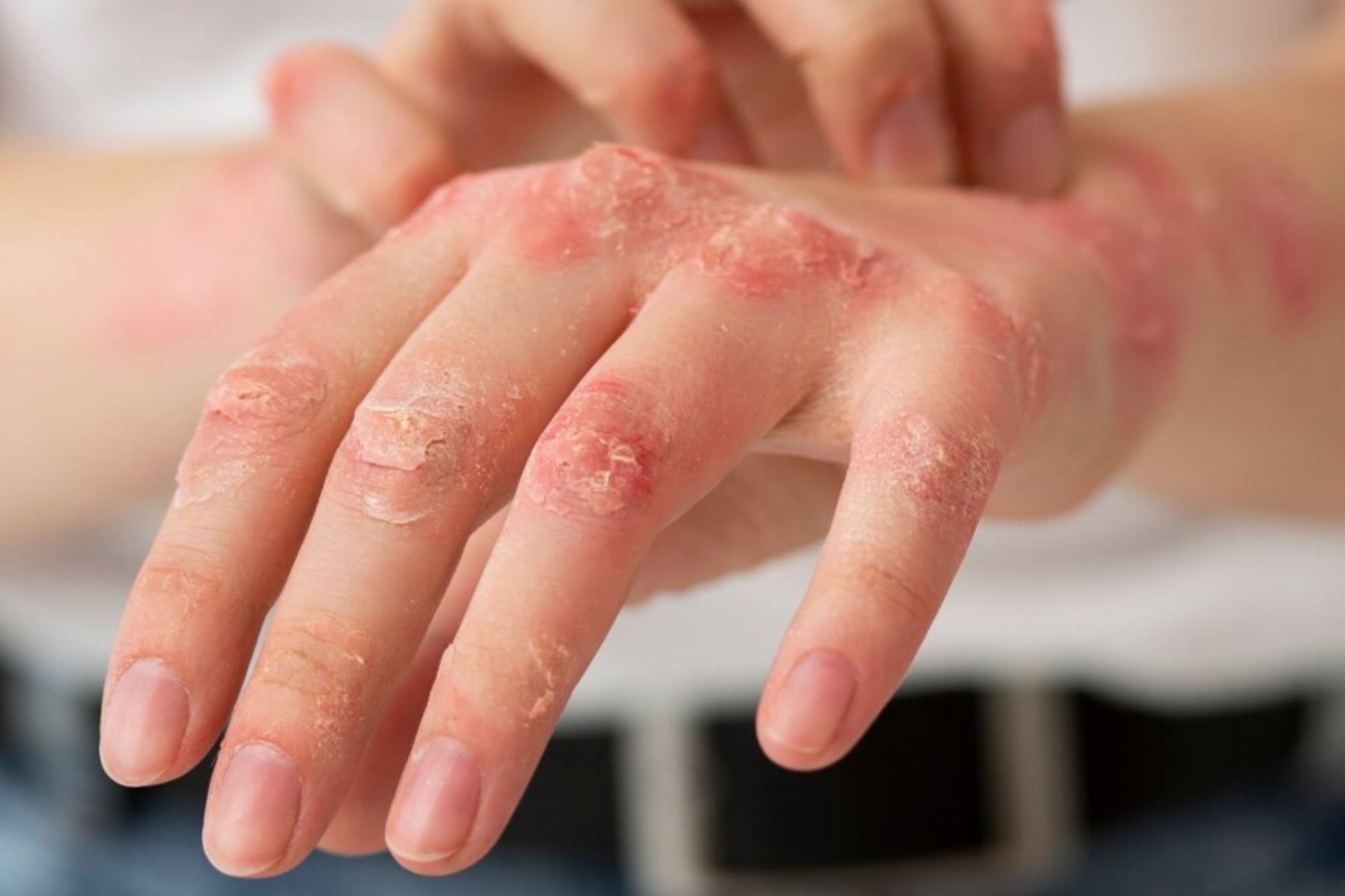 La región dejó de ser libre de sarampión y se activan alertas sanitarias