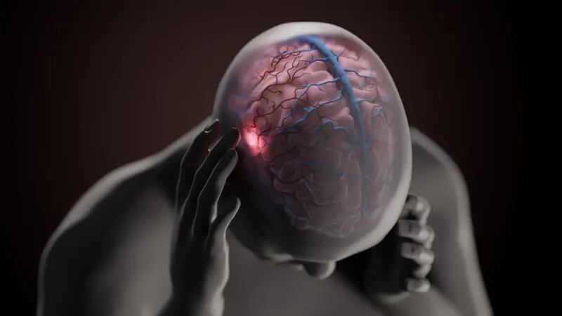 Los científicos que estudian la migraña se han visto desconcertados por la gran variedad de desencadenantes del trastorno