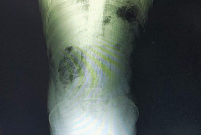 La radiografía de uno de los individuos que denota la presencia de las cápsulas
Foto: Ministerio de Seguridad Nacional
