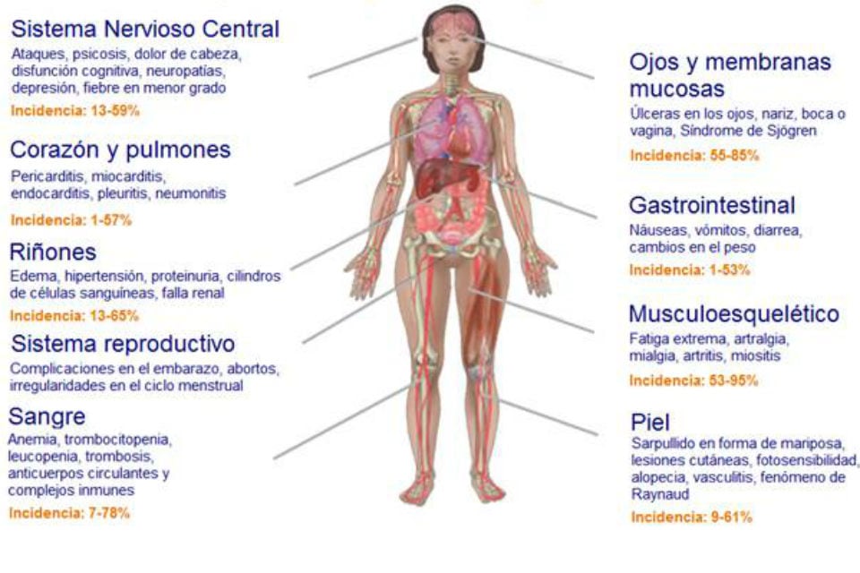 Síntomas del Lupus