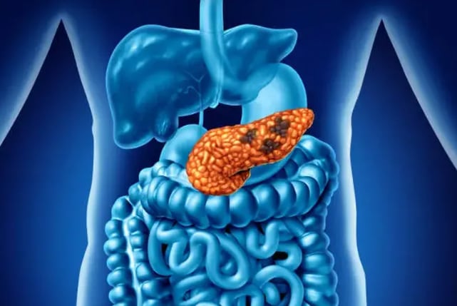 Cáncer de páncreas: un especialista explicó en detalle por qué en España lograron eliminarlo en ratones y cómo funciona