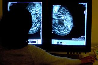 Por qué es importante educar sobre salud mamaria