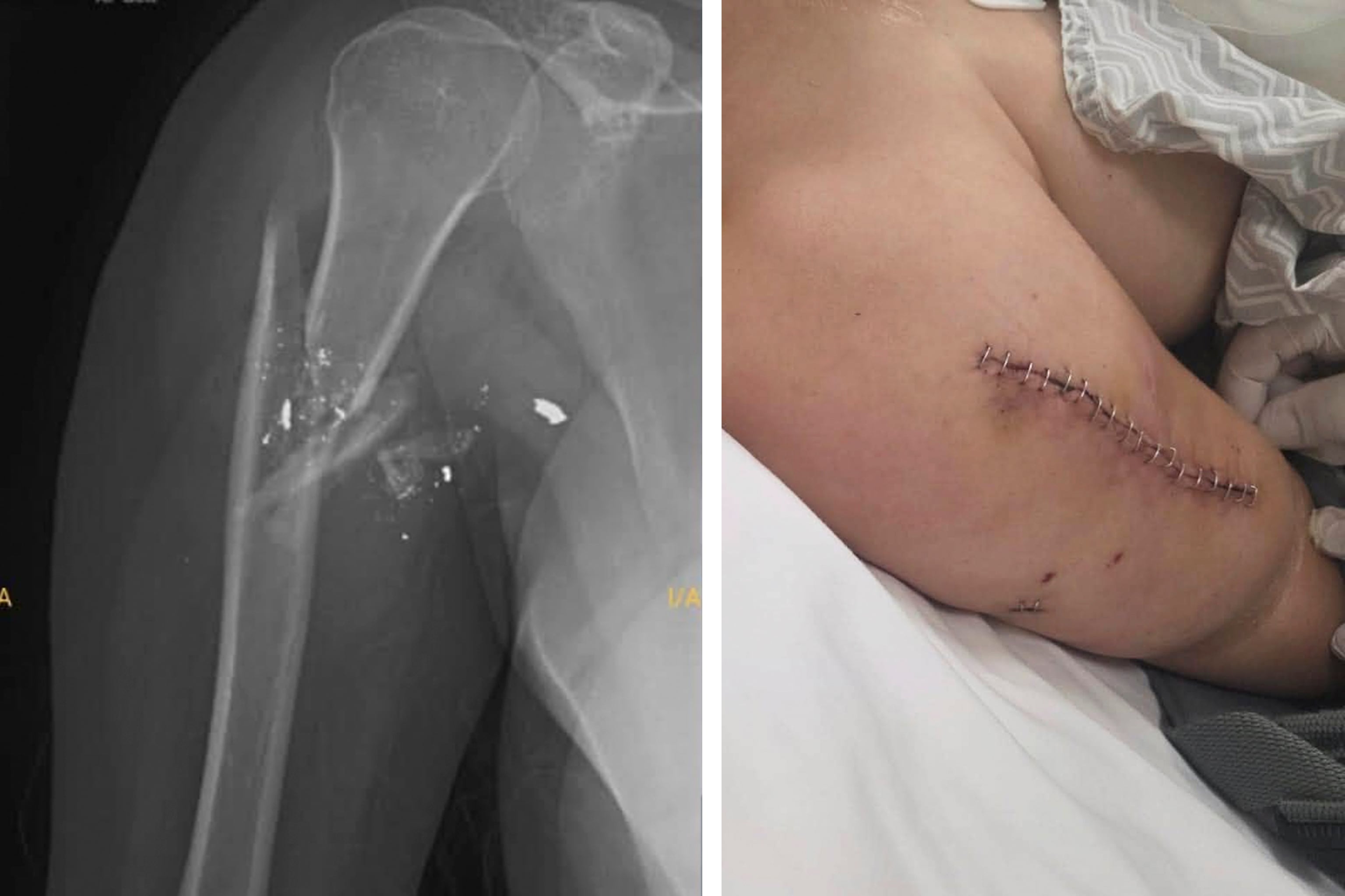 El brazo fracturado de Nadia Beller