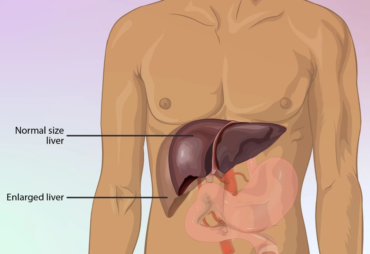 Hígado graso: las estrategias naturales más efectivas para reducirlo y mejorar la salud desde casa