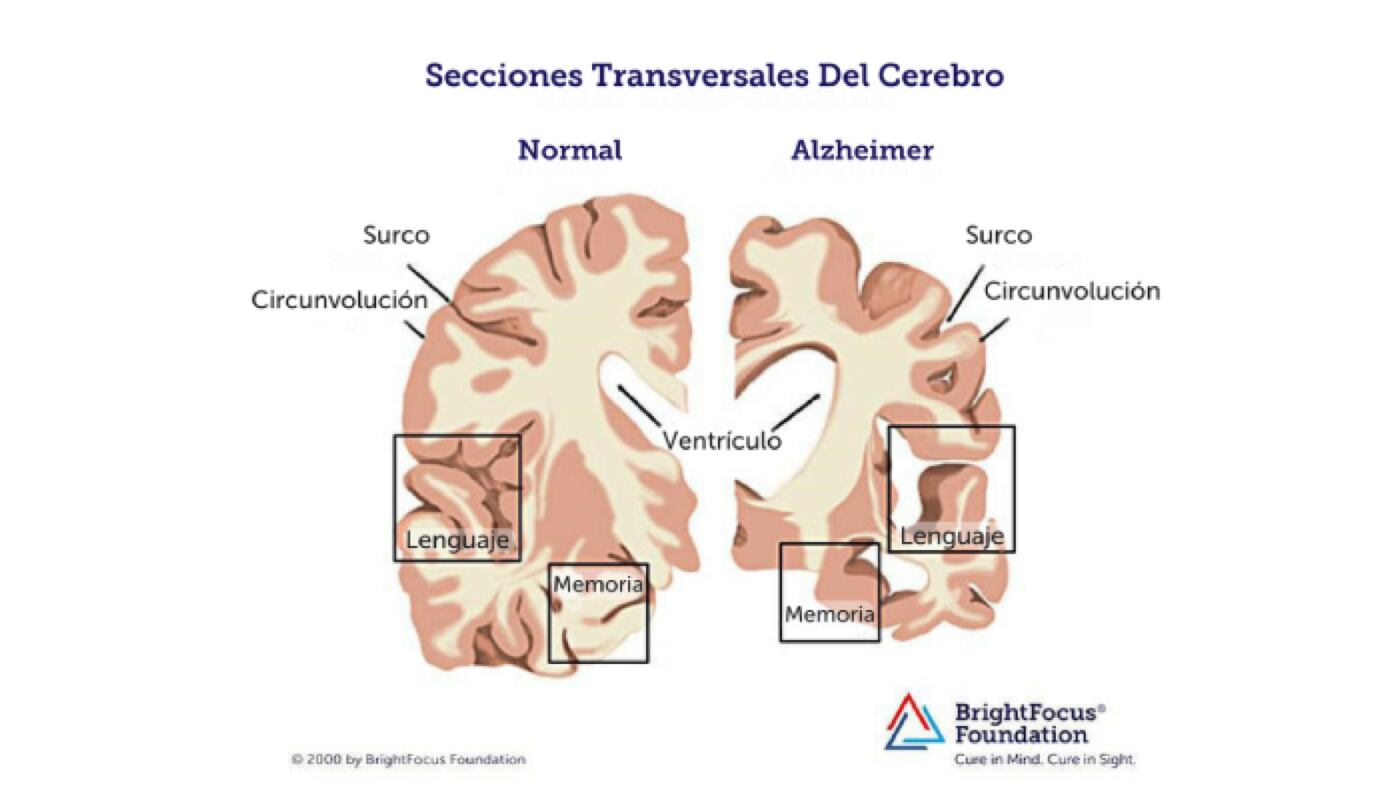 Así luce un cerebro con Alzheimer. Imagen: Brightfocus 2021