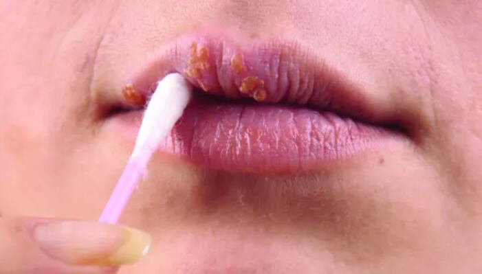 Las verrugas producidas por el HPV pueden aparecer en varias zonas del cuerpo