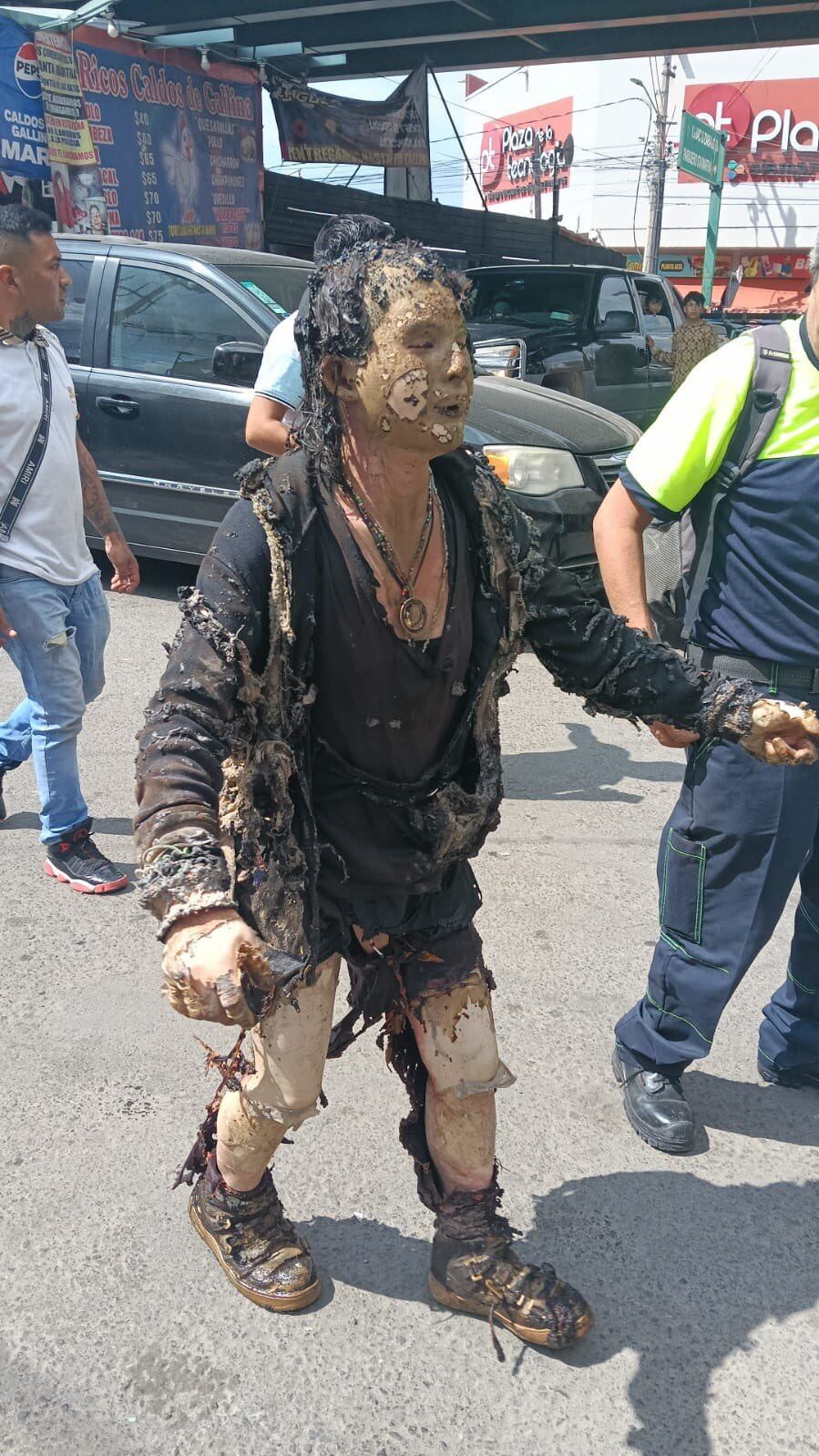 Una mujer con importantes quemaduras en su cuerpo