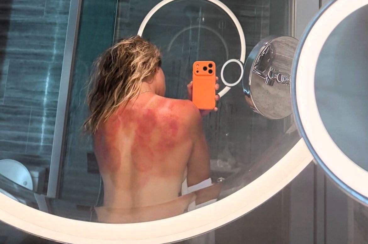 La imagen de la mexicana Renata Zarazúa con la espalda quemada que encendió las alarmas en la previa del Abierto de Australia