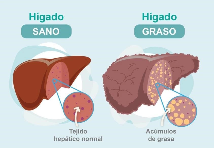 El “hígado graso”, también denominado “esteatosis hepática” supone el depósito excesivo de grasa en el hígado (imagen ilustrativa)