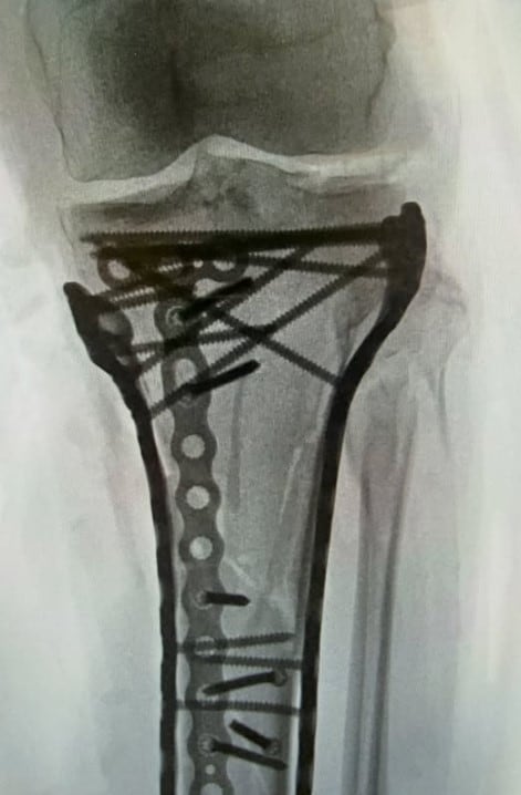 La estructura metálica que sostiene la pierna de Lindsey Vonn