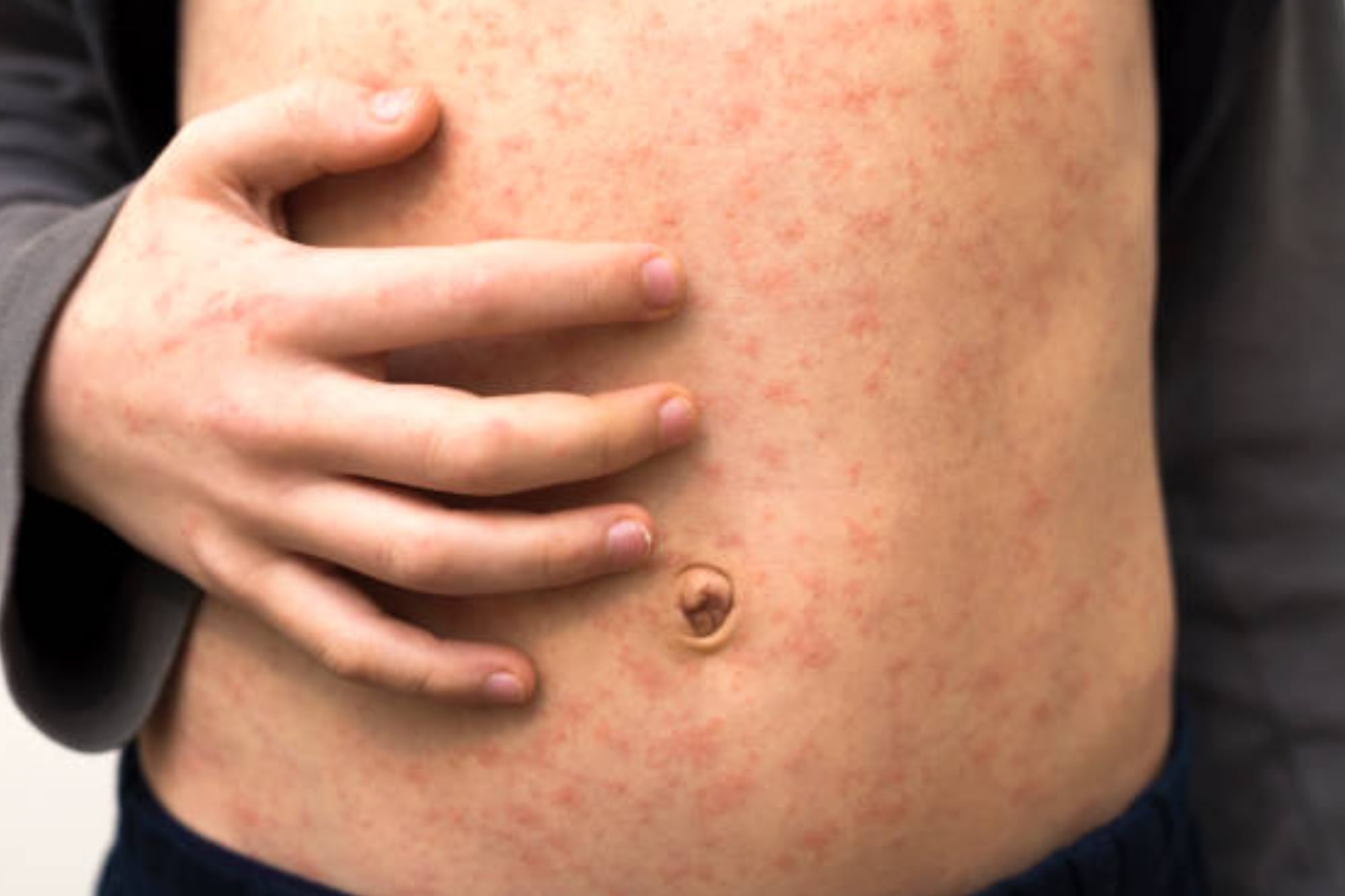 Cómo diferenciar la varicela del sarampión: similitudes y diferencias de sus síntomas y tratamientos