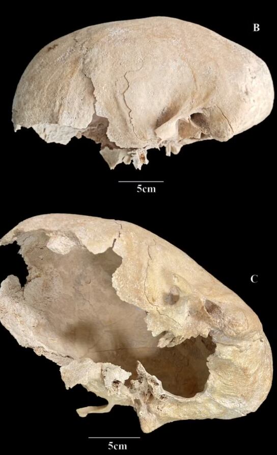 Encontraron un cráneo medieval y al estudiarlo se quedaron sin palabras: “Rara condición” 6 Hallazgo: el cráneo encontrado presentaba una rara anomalía genética