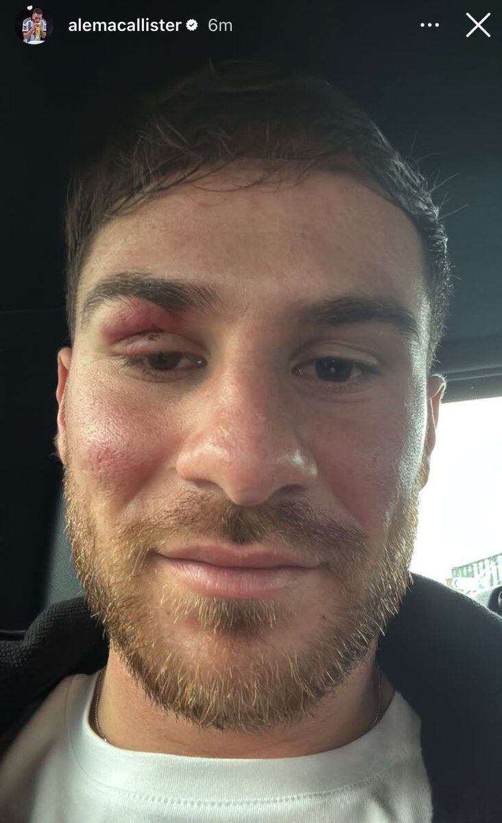 Así quedó el rostro de Alexis Mac Allister después del duro choque en el campo de juego