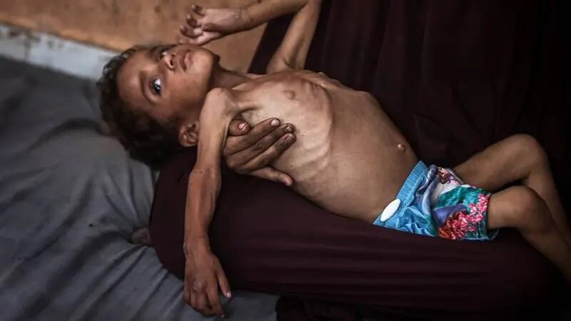 Yezen Abu Ful, de 2 años, lucha por sobrevivir en el campo de refugiados de Al-Shati en el norte de Gaza