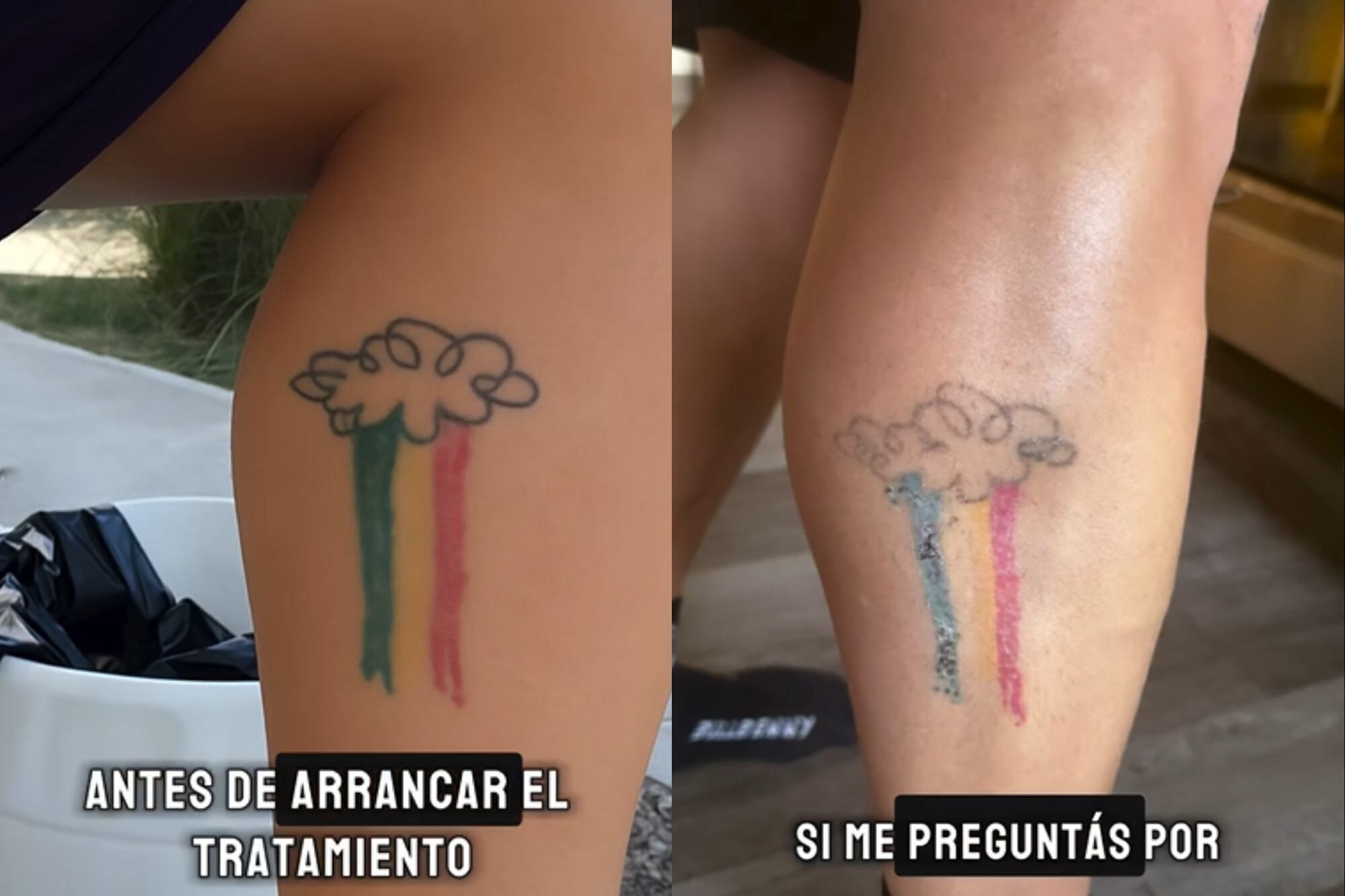 Santiago Maratea mostró cómo está su tatuaje tras comenzar el procedimiento para borrarlo; hasta la fecha se realizó dos sesiones (Foto: Captura de video / Instagram @santimaratea)