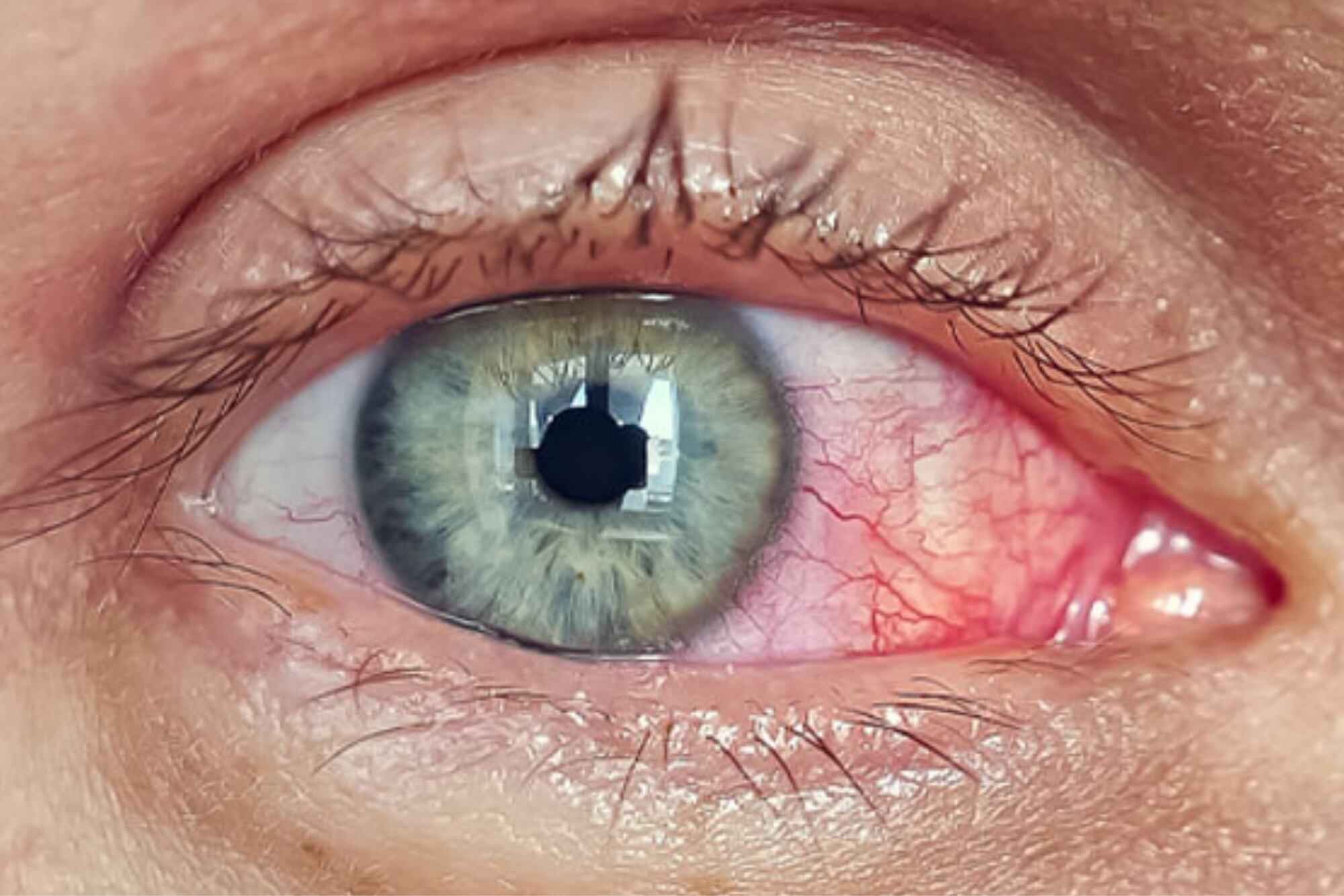 La fotoqueratitis surge por la exposición intensa o prolongada a la luz UV y se presenta con dolor, enrojecimiento y sensibilidad