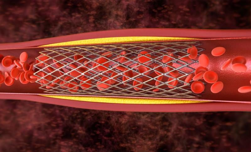 Una de las charlas abordará la evolución de los stents
