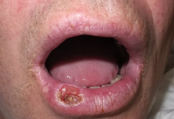 La sífilis suele manifestarse a través de úlceras