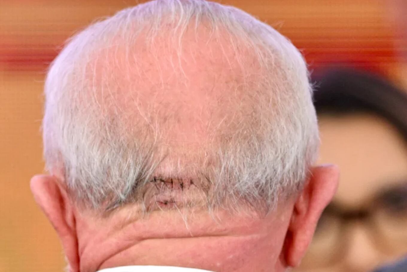 La herida de Lula Da Silva tras caerse en el baño de su casa el pasado 19 de octubre, un golpe que habría motivado la acumulación de líquido intracraneal que llevó al presidente de Brasil a ser operado de emergencia en la noche del lunes 9