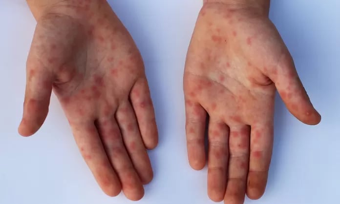 Viruela del mono en la Argentina: cuáles son los síntomas de la variante Mpox Clado Ib