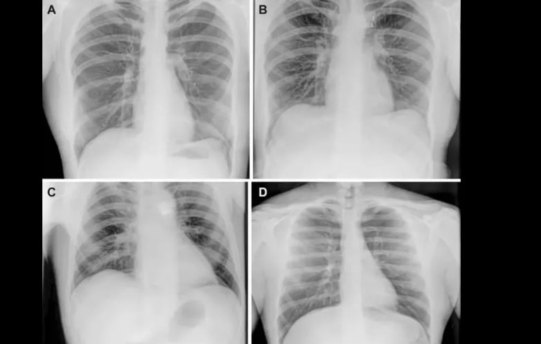 Radiografías de tórax representativas previas al vuelo, durante el vuelo y posteriores al vuelo (Foto: Sociedad Radiológica de Norteamérica (RSNA))