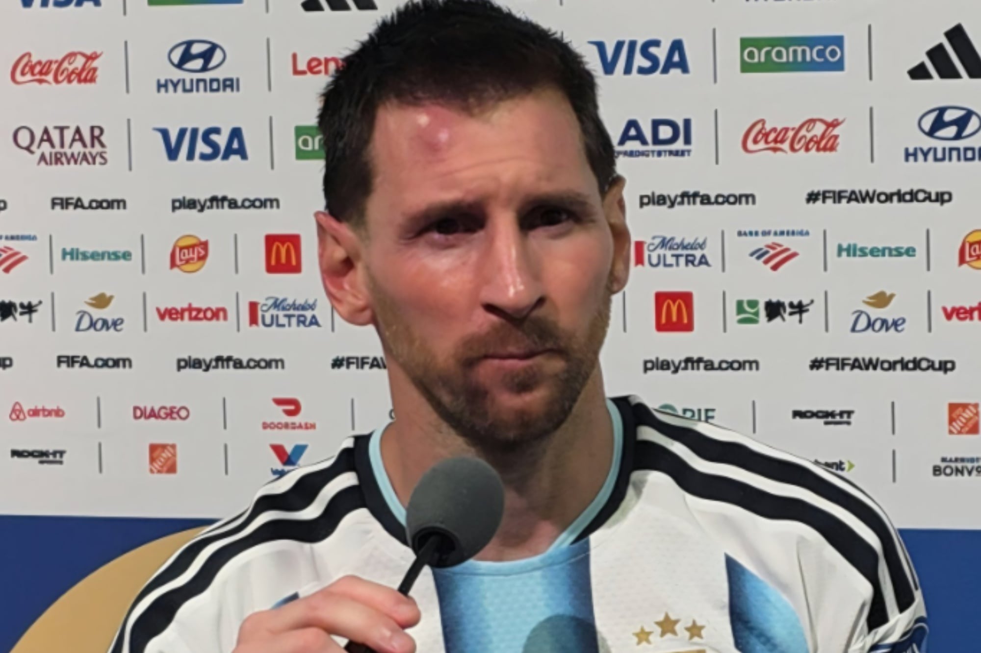 El chichón de Messi tras el partido ante Cabo Verde