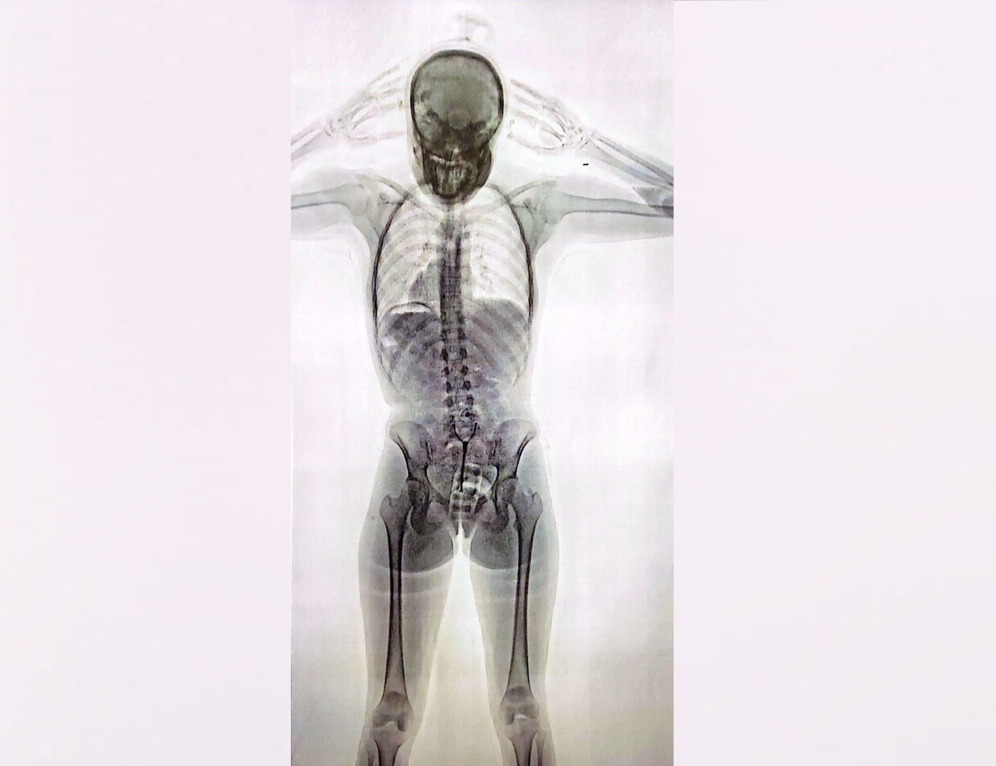 Mula con 78 cápsulas con cocaína en su cuerpo; 11 de ella, por vía intravaginal