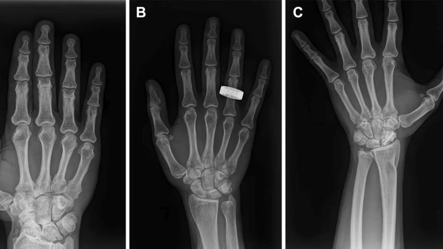 A la izquierda se muestra una radiografía de la mano de un miembro de la tripulación del Fram2 tomada antes del vuelo, en el centro una radiografía tomada en órbita y a la derecha una radiografía tomada después del vuelo (Foto: Sociedad Radiológica de Norteamérica (RSNA))