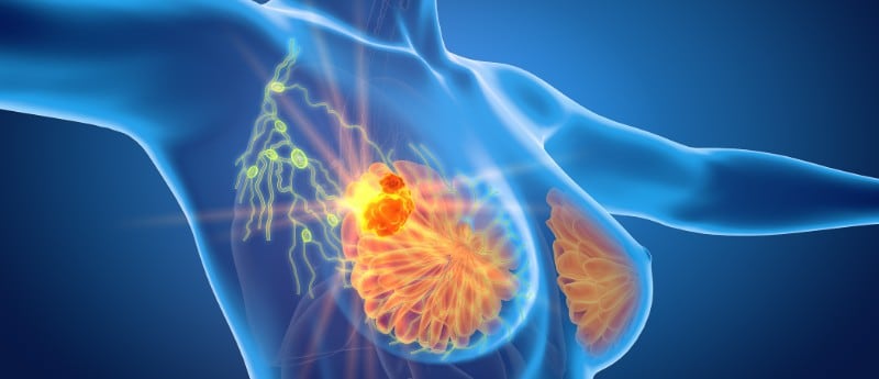 Cáncer de mama