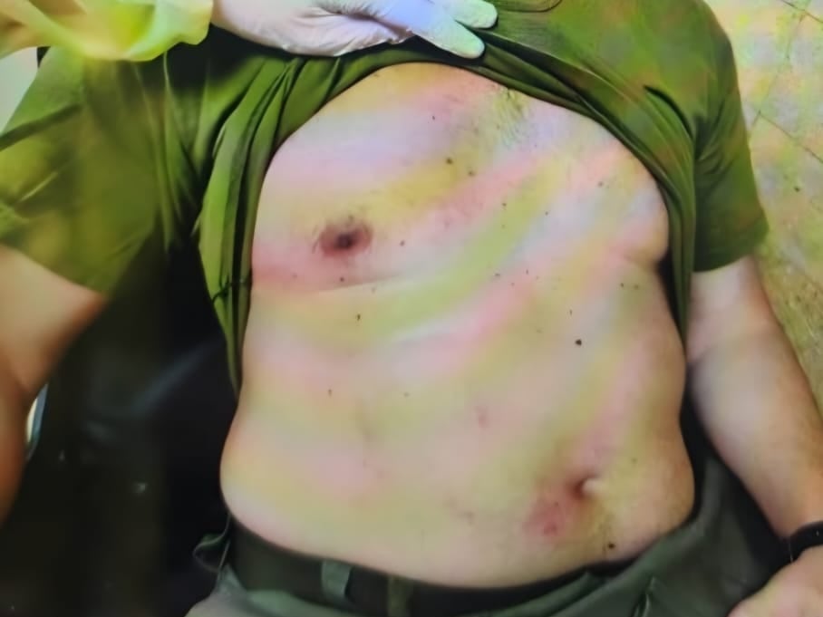 Así quedó uno de los heridos por la explosión de un paquete bomba en la Escuela Superior de Gendarmería