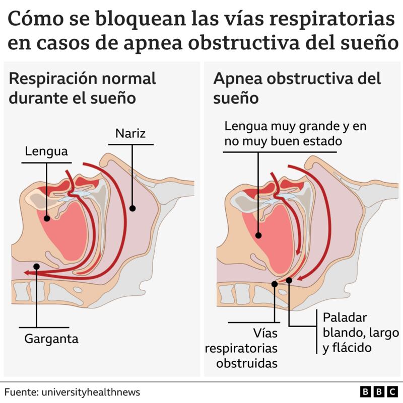 ¿Qué es la apnea de sueño?