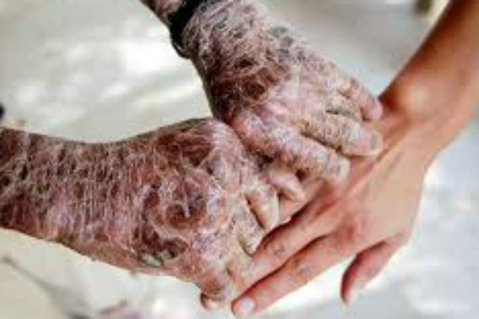 Enfermedades poco frecuentes: Más del 70% de los pacientes recurrió a ahorros o pidió ayuda familiar para su tratamiento