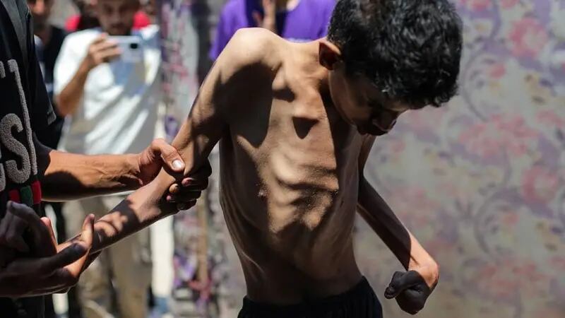 La desnutrición aguda también afecta a los adultos. Hamza Mishmish, de 25 años, en el campo de refugiados de Nuseirat en Deir al-Balah, Gaza