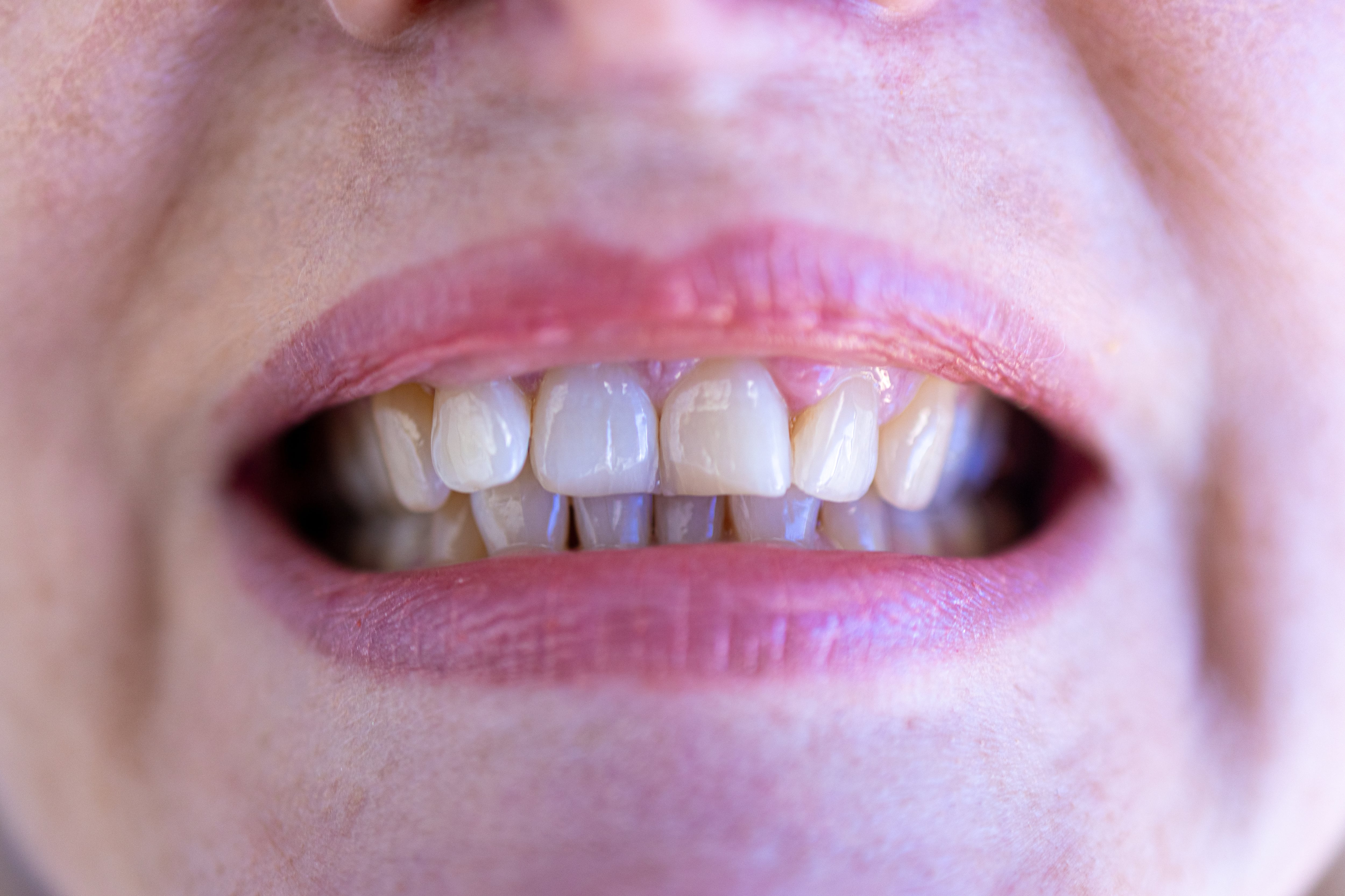 No es raro que los dientes se desplacen con la edad y suele ocurrir más en los dientes inferiores que en los superiores