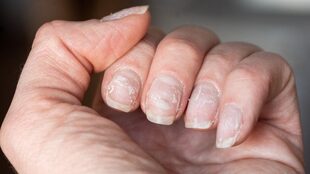Las uñas en forma de cuchara o quebradizas pueden revelar anemia