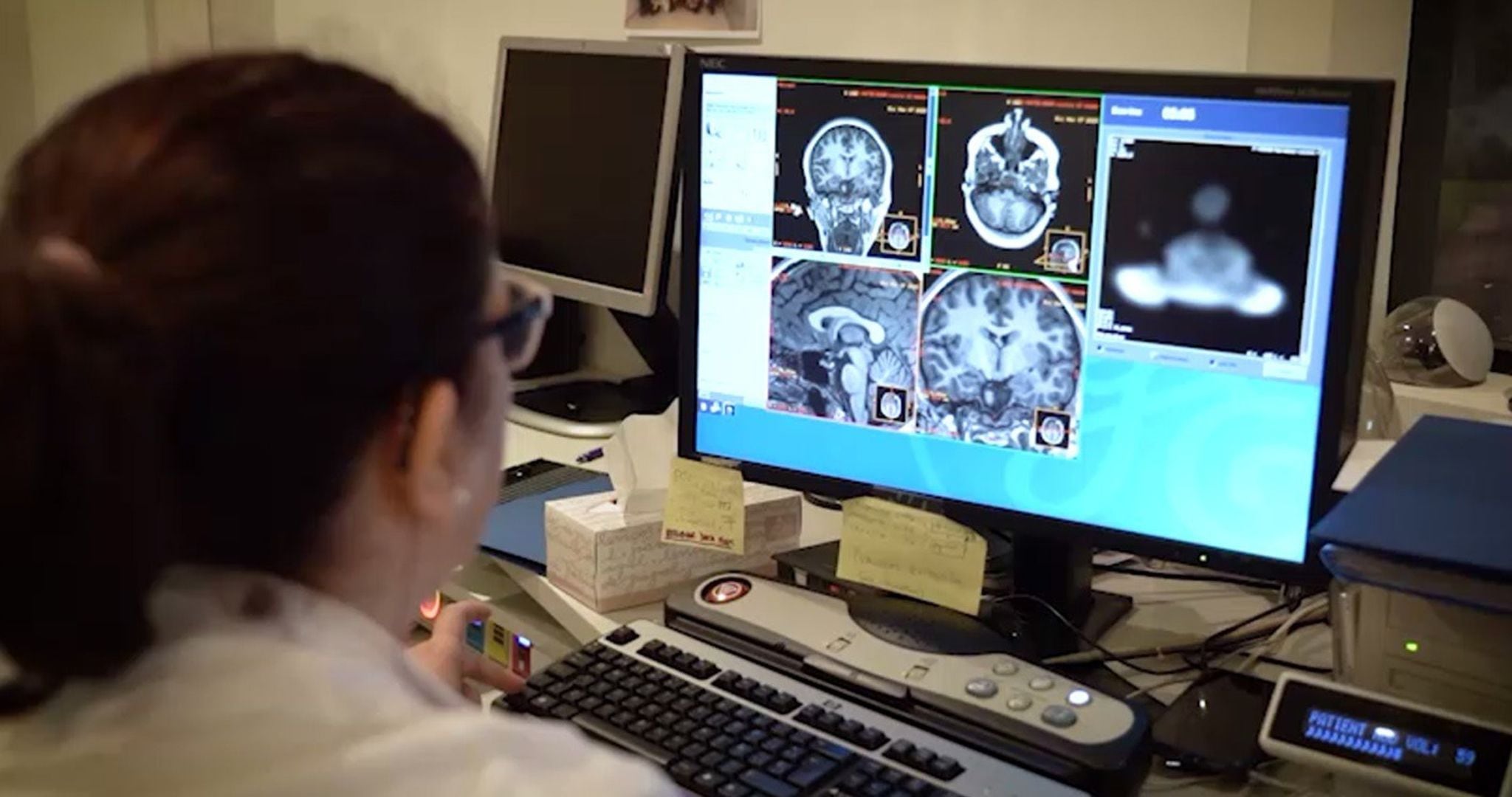 Un diagnóstico de Alzheimer se basa, en parte, en la presencia de placas amiloides en el cerebro