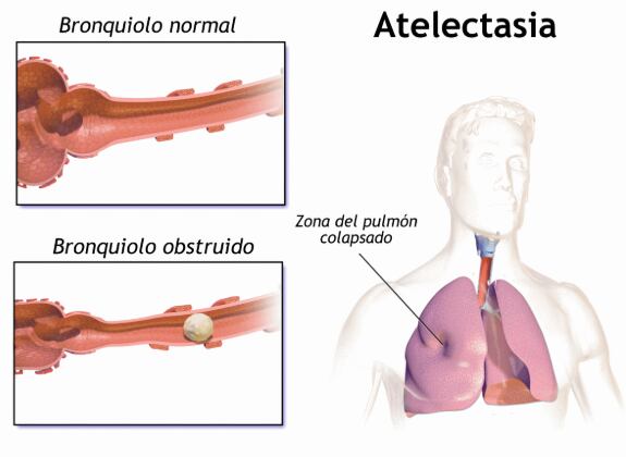 Qué es y de qué forma afecta la atelectasia