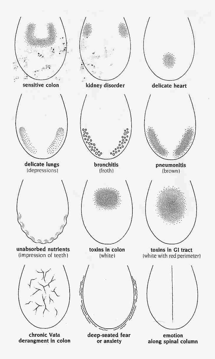 La medicina ayurveda cree que aquello que no se puede digerir se transforma en toxinas que viajan por el cuerpo y se depositan en lugares débiles generando enfermedades