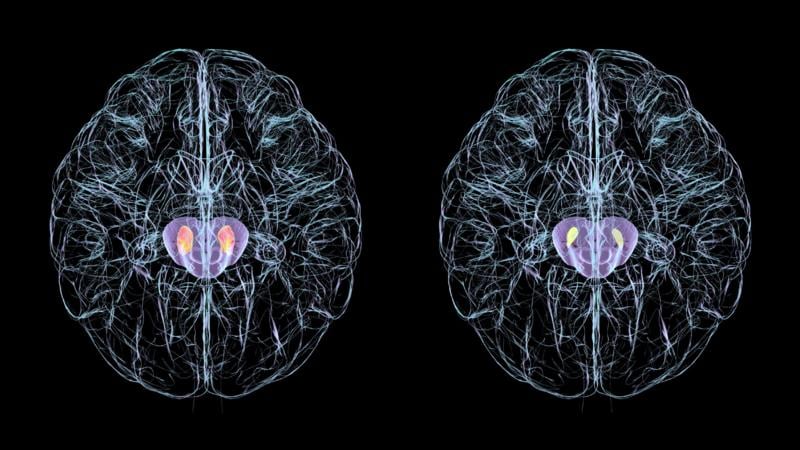 En las personas con Parkinson, las células nerviosas de la región del cerebro conocida como sustancia negra, mueren