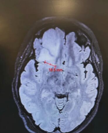 El tumor tenía 6 centímetros de grosor
